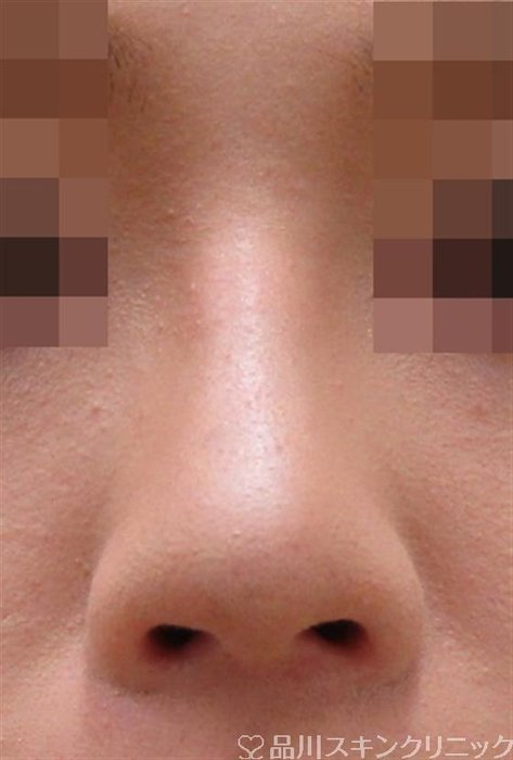 症例NO.32662のAFTER写真