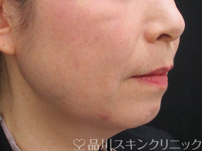 症例NO.73156のAFTER写真