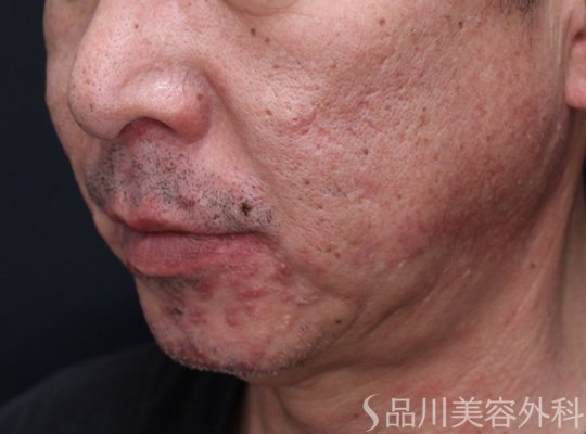 症例NO.72129のBEFORE写真