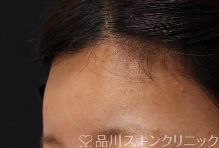 症例NO.63936のAFTER写真
