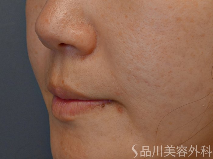 症例NO.71510のBEFORE写真