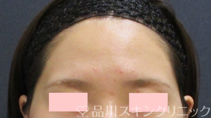 症例NO.69554のBEFORE写真