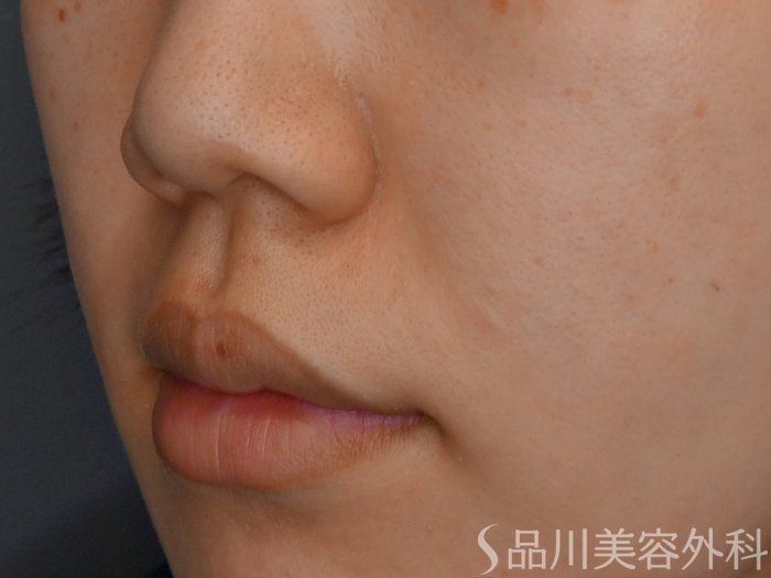 症例NO.70388のBEFORE写真