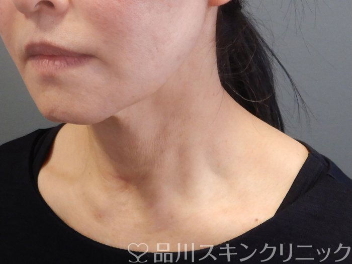 症例NO.74942のAFTER写真