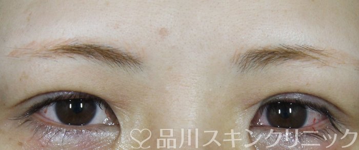 症例NO.70142のAFTER写真