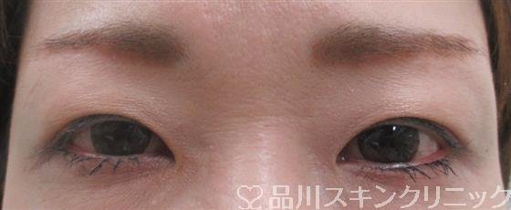 症例NO.26760のAFTER写真
