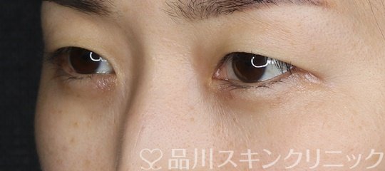 症例NO.75084のAFTER写真