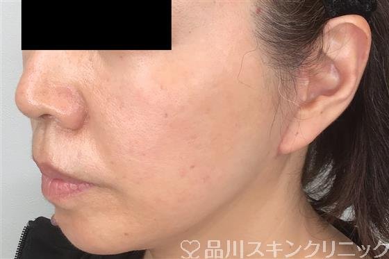 症例NO.55155のAFTER写真