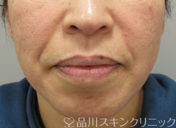 症例NO.69810のBEFORE写真