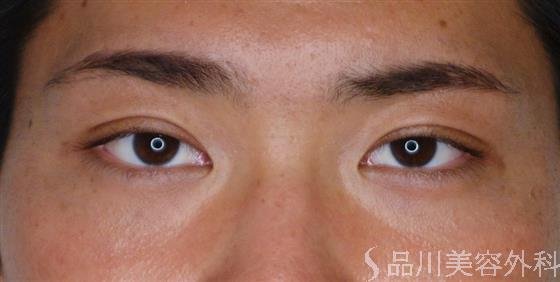 症例NO.48481のAFTER写真