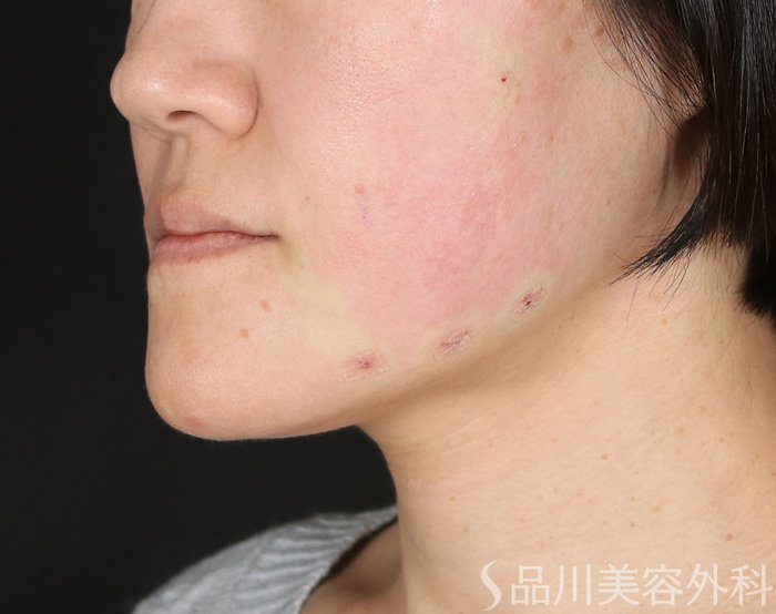 症例NO.73185のAFTER写真