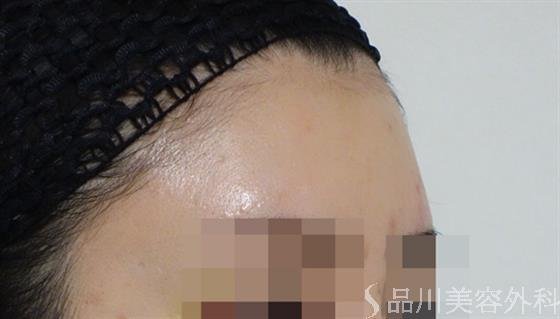症例NO.47181のAFTER写真