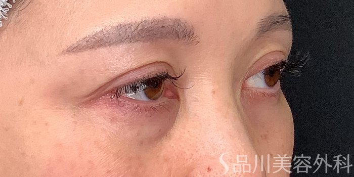 症例NO.71229のBEFORE写真