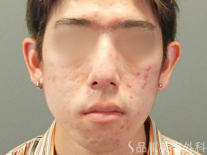 症例NO.65499のBEFORE写真