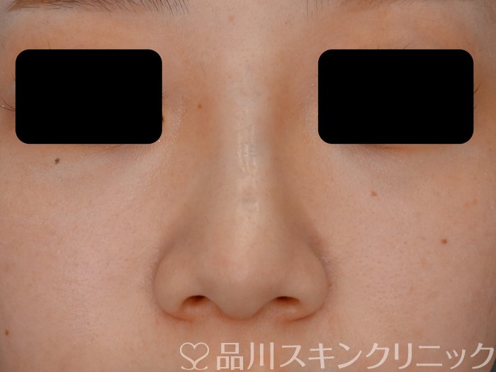 症例NO.70949のAFTER写真