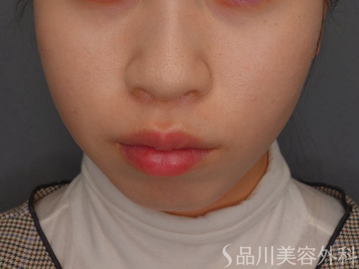 症例NO.73609のAFTER写真