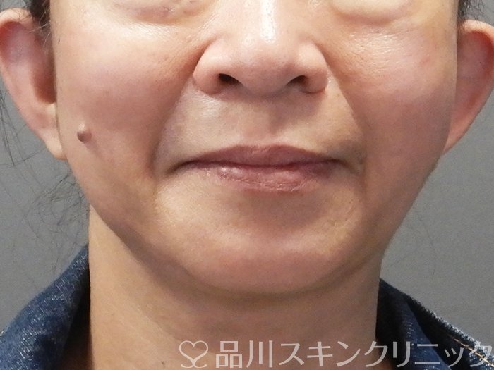 症例NO.73522のAFTER写真