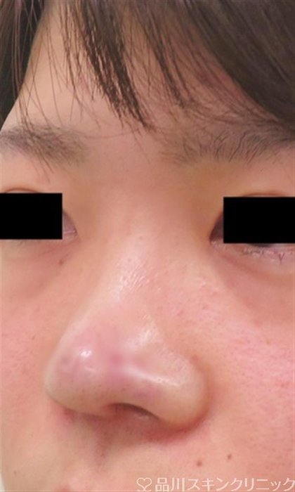 症例NO.46977のAFTER写真