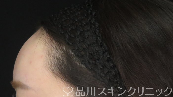 症例NO.71050のAFTER写真