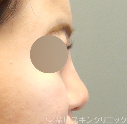 症例NO.62986のAFTER写真