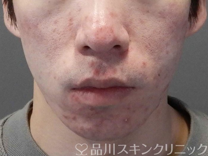 症例NO.67043のBEFORE写真