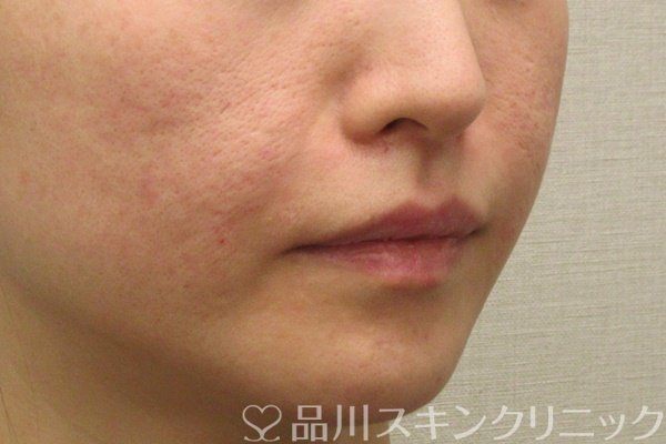 症例NO.72746のAFTER写真