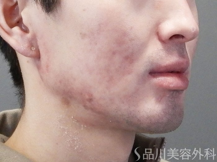 症例NO.73146のAFTER写真