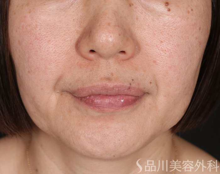 症例NO.73161のBEFORE写真