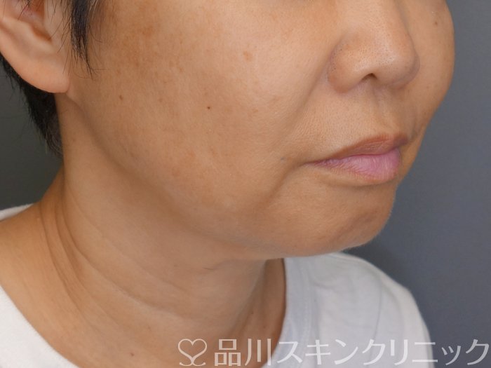 症例NO.71336のBEFORE写真