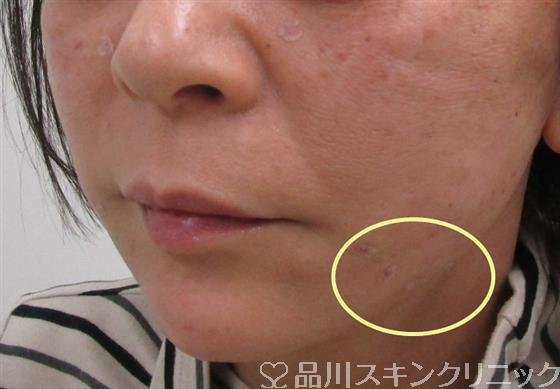 症例NO.34501のAFTER写真