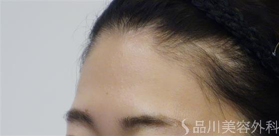 症例NO.48424のBEFORE写真