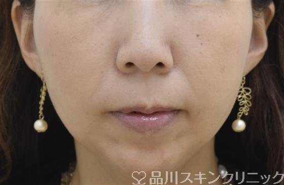症例NO.43230のAFTER写真