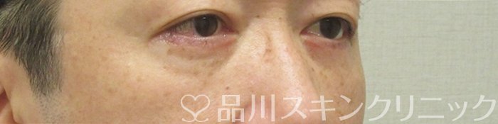 症例NO.74836のAFTER写真