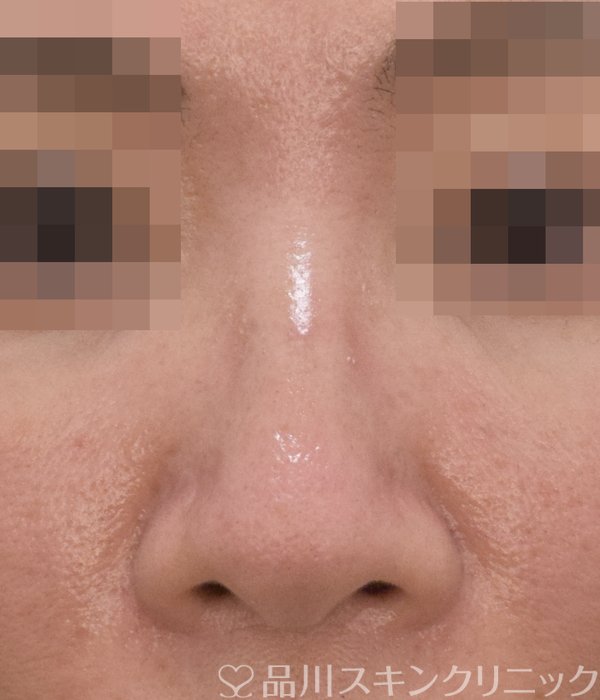 症例NO.73335のBEFORE写真