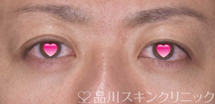 症例NO.62309のAFTER写真