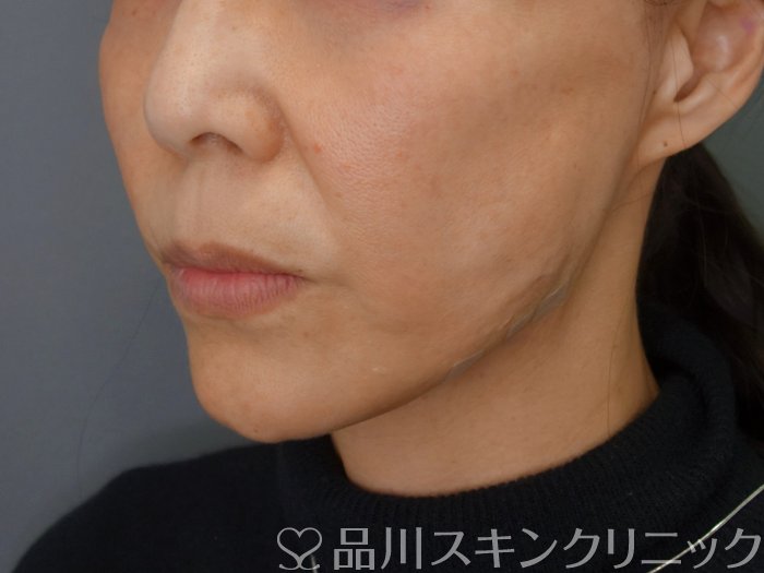 症例NO.74164のAFTER写真