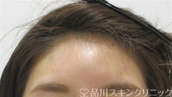 症例NO.32055のAFTER写真