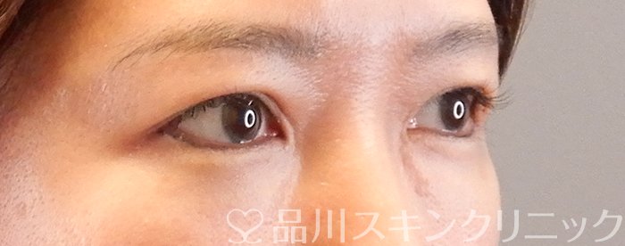 症例NO.63407のAFTER写真