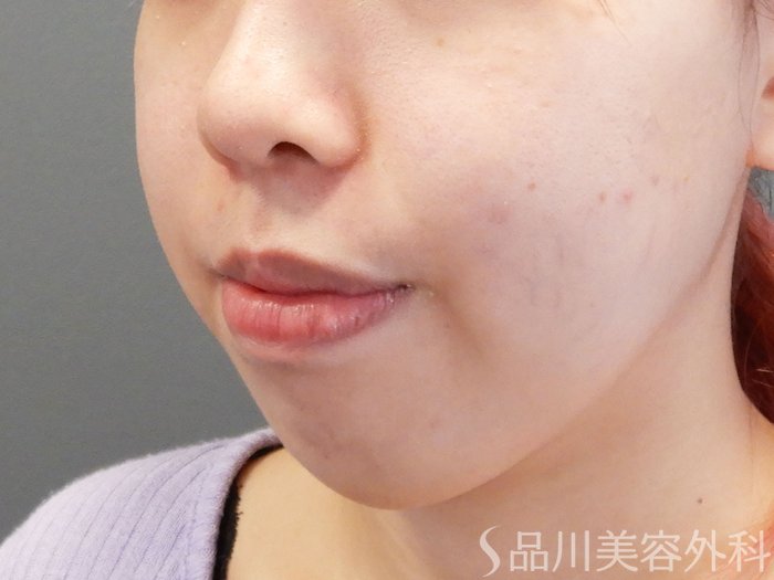 症例NO.70194のBEFORE写真