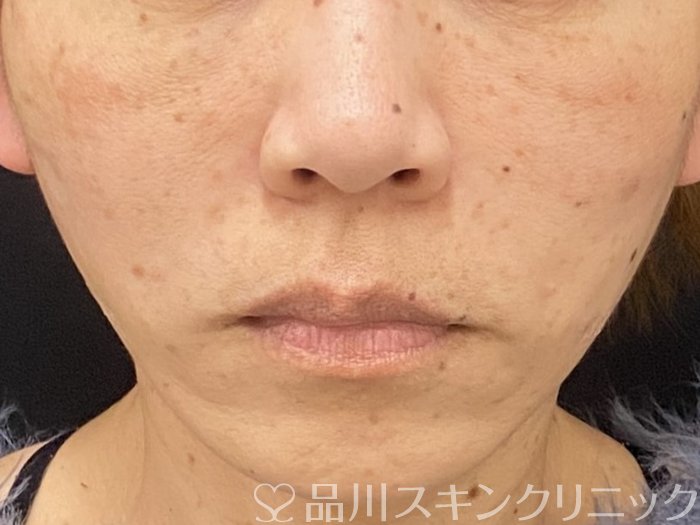 症例NO.73583のAFTER写真
