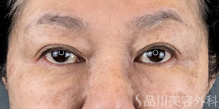 症例NO.70958のBEFORE写真