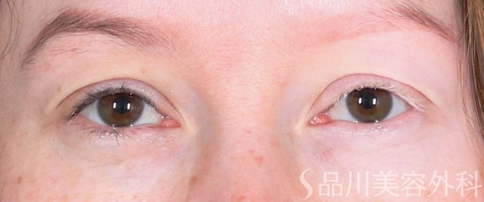 症例NO.73807のBEFORE写真