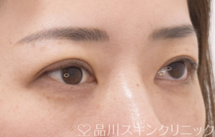 症例NO.70969のAFTER写真