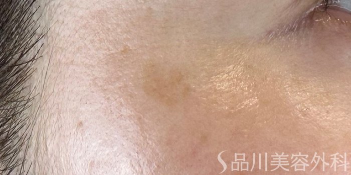 症例NO.71524のBEFORE写真