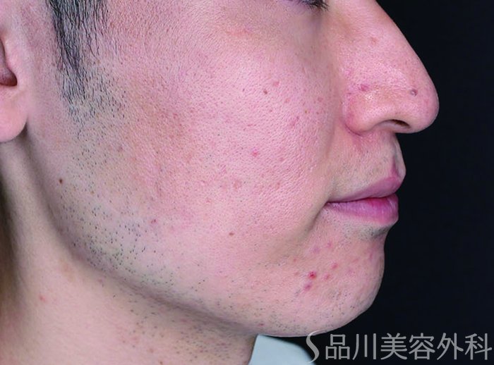症例NO.70964のBEFORE写真
