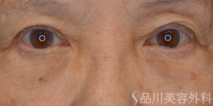 症例NO.72748のBEFORE写真