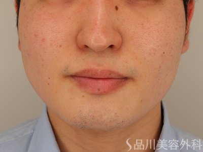 症例NO.72511のAFTER写真