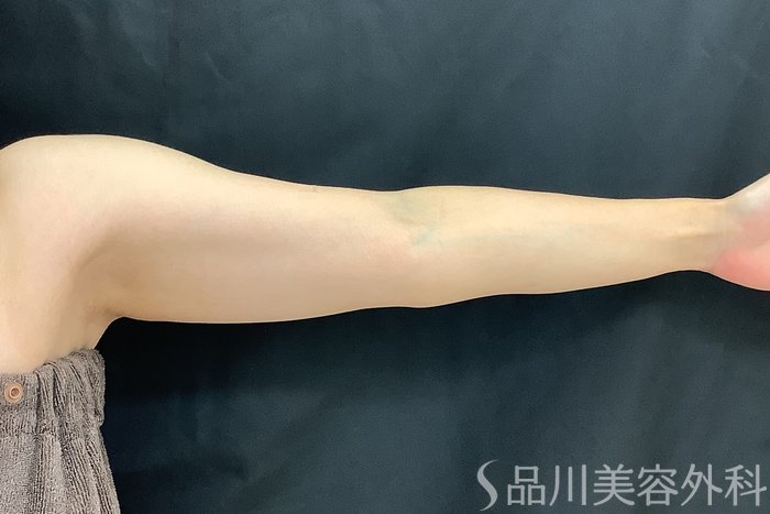 症例NO.69545のAFTER写真