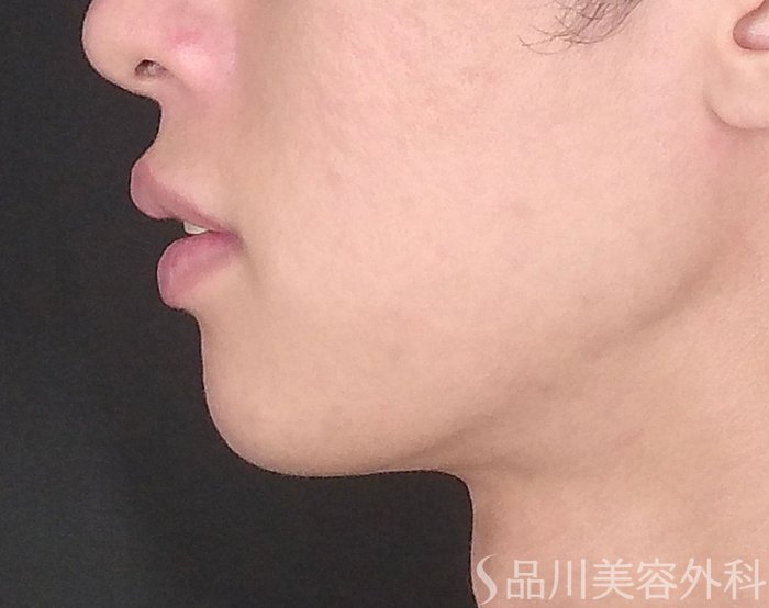 症例NO.65243のBEFORE写真