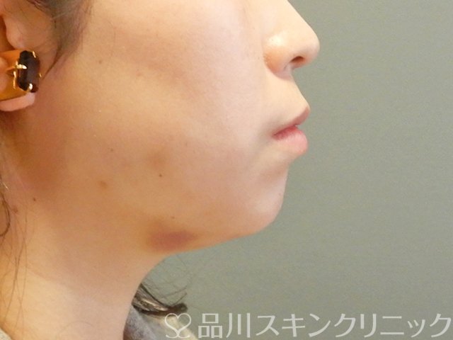 症例NO.63593のBEFORE写真